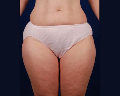 Liposuction Before & After Gallery - Patient 199602 - Image 1