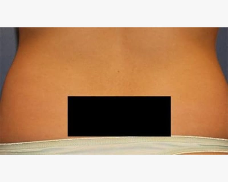 Liposuction Before & After Gallery - Patient 240650 - Image 5