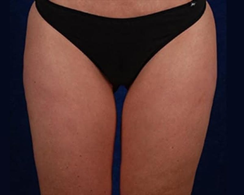 Liposuction Before & After Gallery - Patient 935358 - Image 2