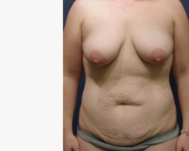 Mommy Makeover Before & After Gallery - Patient 362650 - Image 1