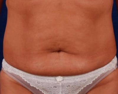 Tummy Tuck Before & After Gallery - Patient 121330 - Image 1