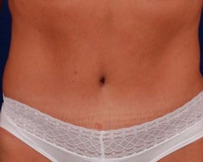 Tummy Tuck Before & After Gallery - Patient 121330 - Image 2