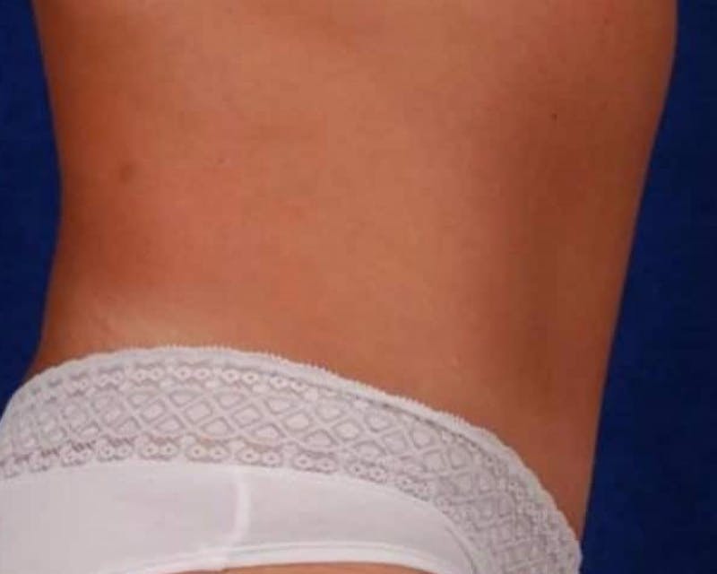 Tummy Tuck Before & After Gallery - Patient 121330 - Image 4