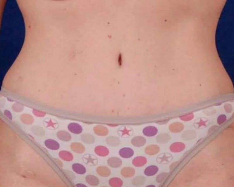 Tummy Tuck Before & After Gallery - Patient 694088 - Image 2