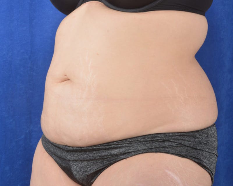 Tummy Tuck Before & After Gallery - Patient 298619 - Image 3