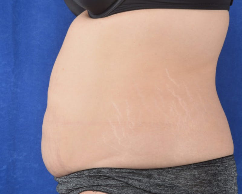 Tummy Tuck Before & After Gallery - Patient 298619 - Image 5