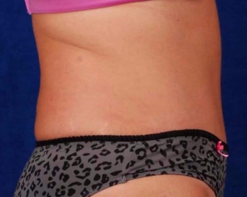 Tummy Tuck Before & After Gallery - Patient 633774 - Image 4