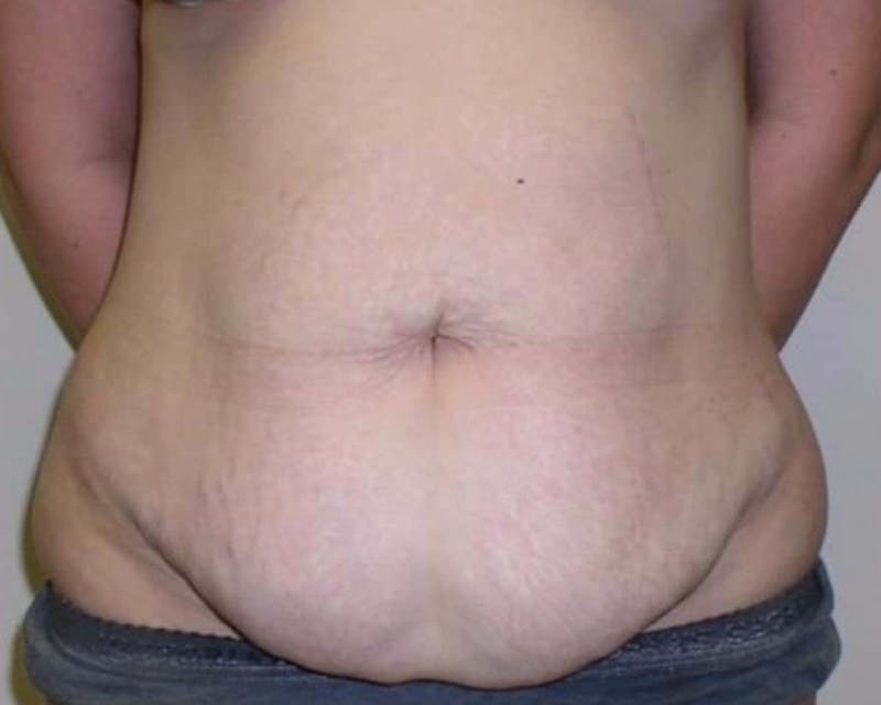 Tummy Tuck Before & After Gallery - Patient 329940 - Image 1