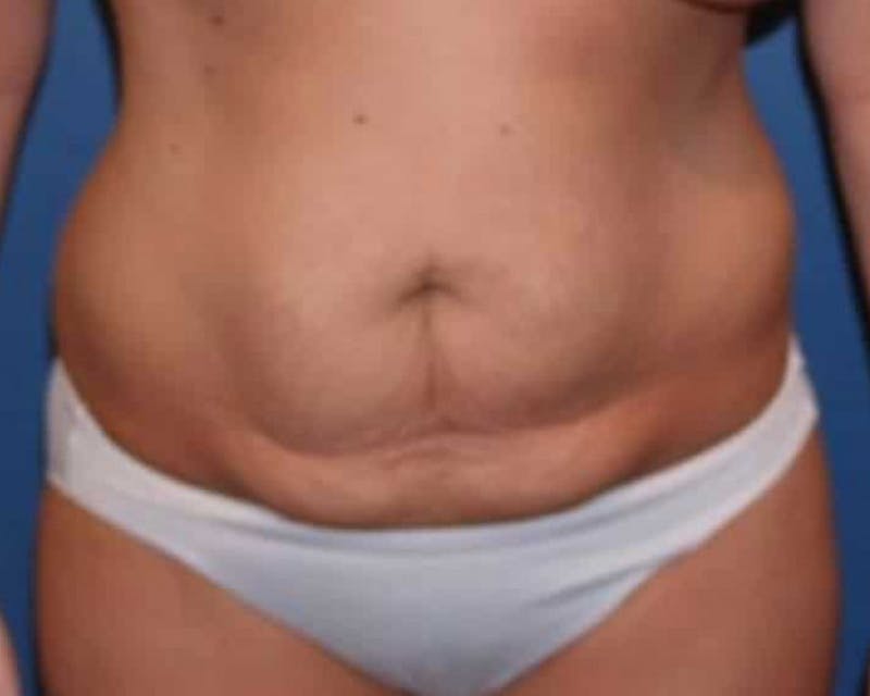 Tummy Tuck Before & After Gallery - Patient 240090 - Image 1