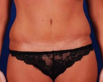Tummy Tuck Before & After Gallery - Patient 240090 - Image 2