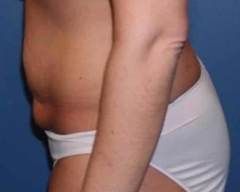 Tummy Tuck Before & After Gallery - Patient 240090 - Image 3