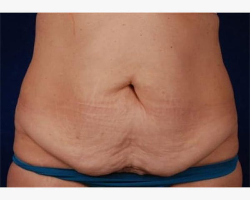 Tummy Tuck Before & After Gallery - Patient 359458 - Image 1