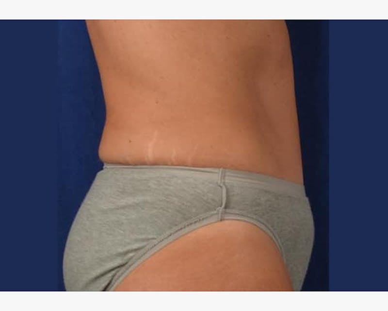 Tummy Tuck Before & After Gallery - Patient 359458 - Image 4