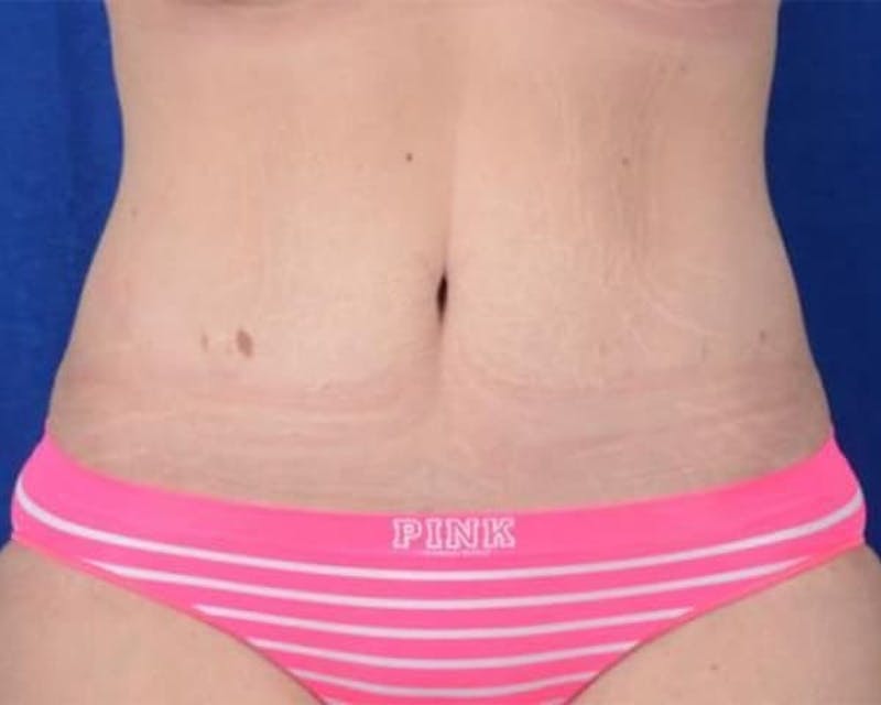 Tummy Tuck Before & After Gallery - Patient 260428 - Image 2