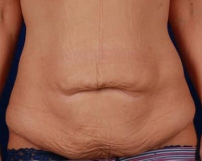 Tummy Tuck Before & After Gallery - Patient 298097 - Image 1