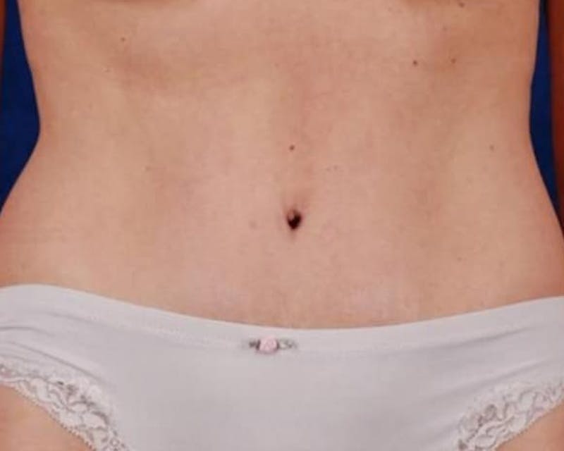 Tummy Tuck Before & After Gallery - Patient 130252 - Image 2