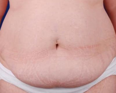 Tummy Tuck Before & After Gallery - Patient 866083 - Image 1