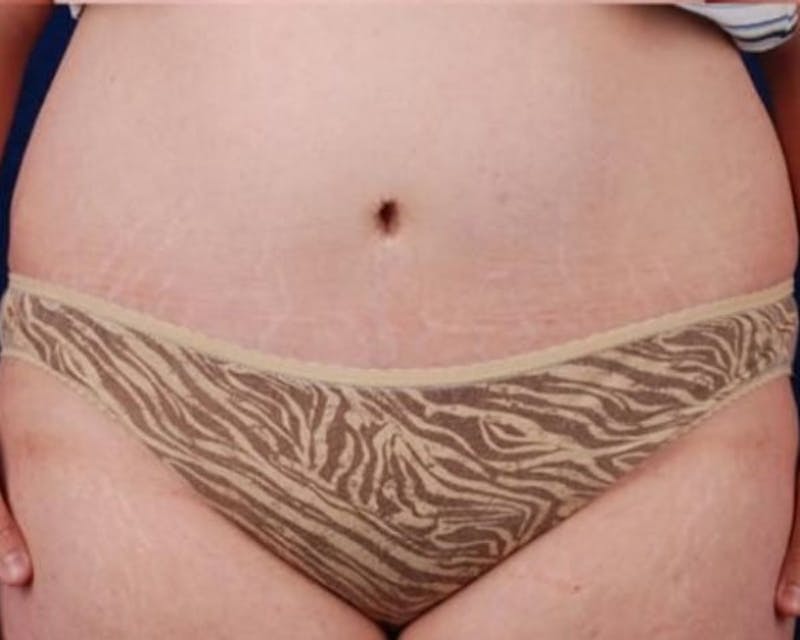 Tummy Tuck Before & After Gallery - Patient 866083 - Image 2