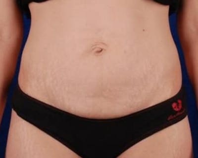 Tummy Tuck Before & After Gallery - Patient 479969 - Image 1