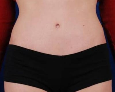 Tummy Tuck Before & After Gallery - Patient 479969 - Image 2