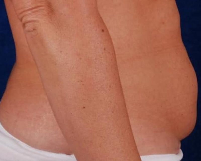Tummy Tuck Before & After Gallery - Patient 370033 - Image 1