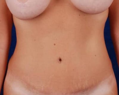 Tummy Tuck Before & After Gallery - Patient 267664 - Image 2