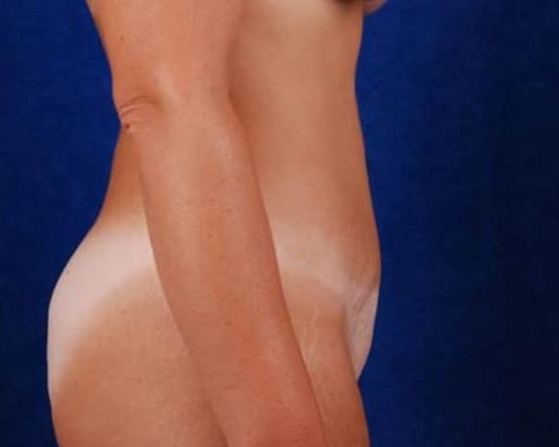 Tummy Tuck Before & After Gallery - Patient 267664 - Image 4