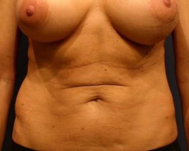 Tummy Tuck Before & After Gallery - Patient 425185 - Image 1