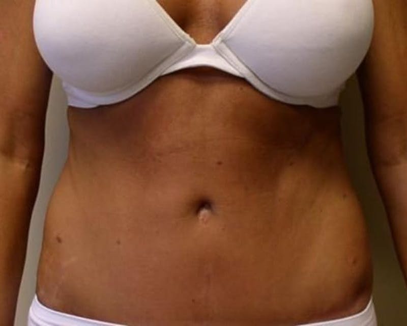Tummy Tuck Before & After Gallery - Patient 425185 - Image 2