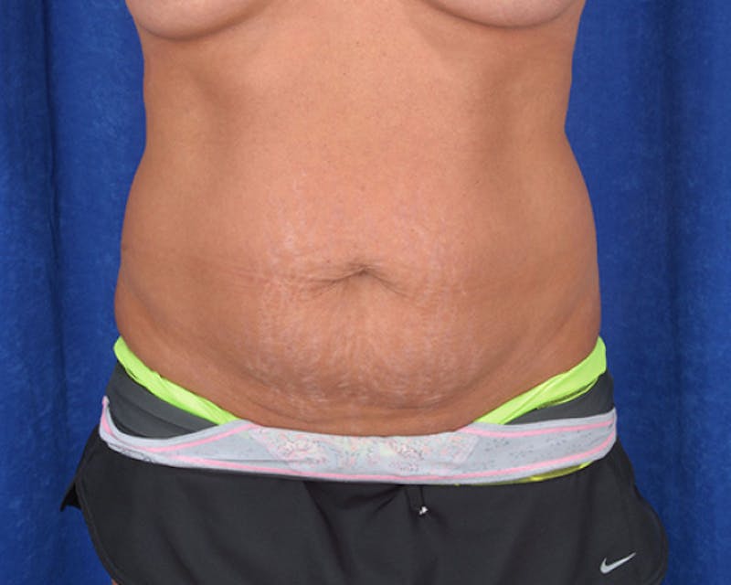 Tummy Tuck Before & After Gallery - Patient 307018 - Image 1