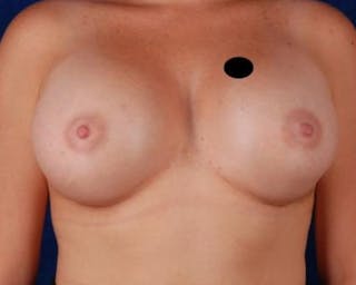 Breast Augmentation Before & After Gallery - Patient 366961 - Image 2
