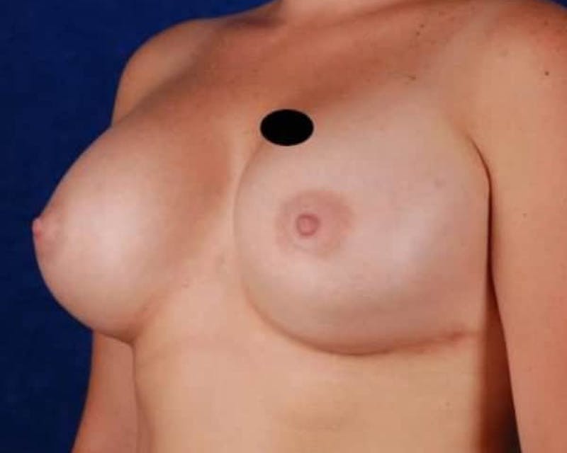 Breast Augmentation Before & After Gallery - Patient 366961 - Image 4