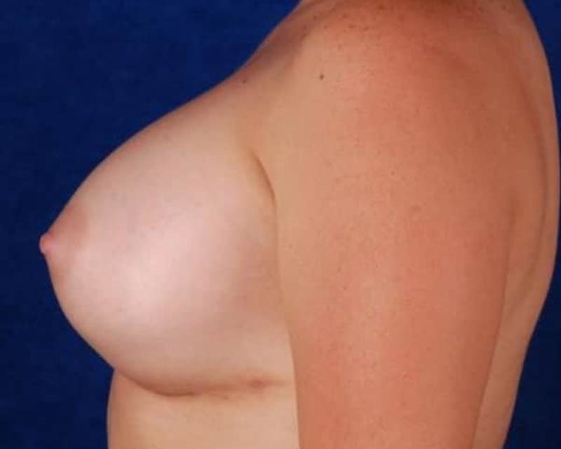 Breast Augmentation Before & After Gallery - Patient 366961 - Image 6