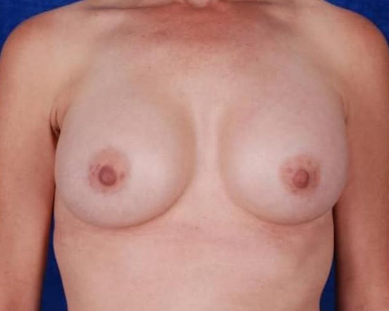 Breast Augmentation Before & After Gallery - Patient 103041 - Image 2