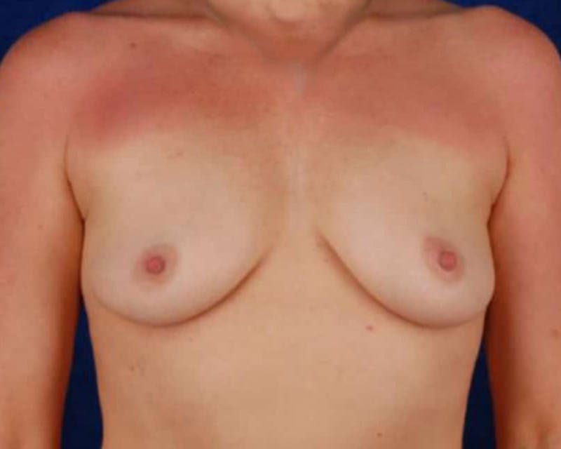 Breast Augmentation Before & After Gallery - Patient 285670 - Image 1