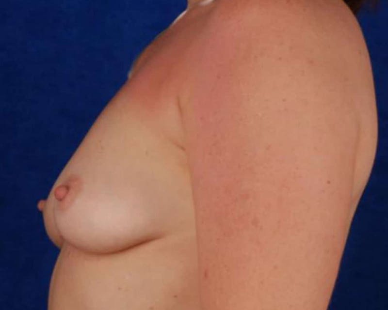 Breast Augmentation Before & After Gallery - Patient 285670 - Image 5