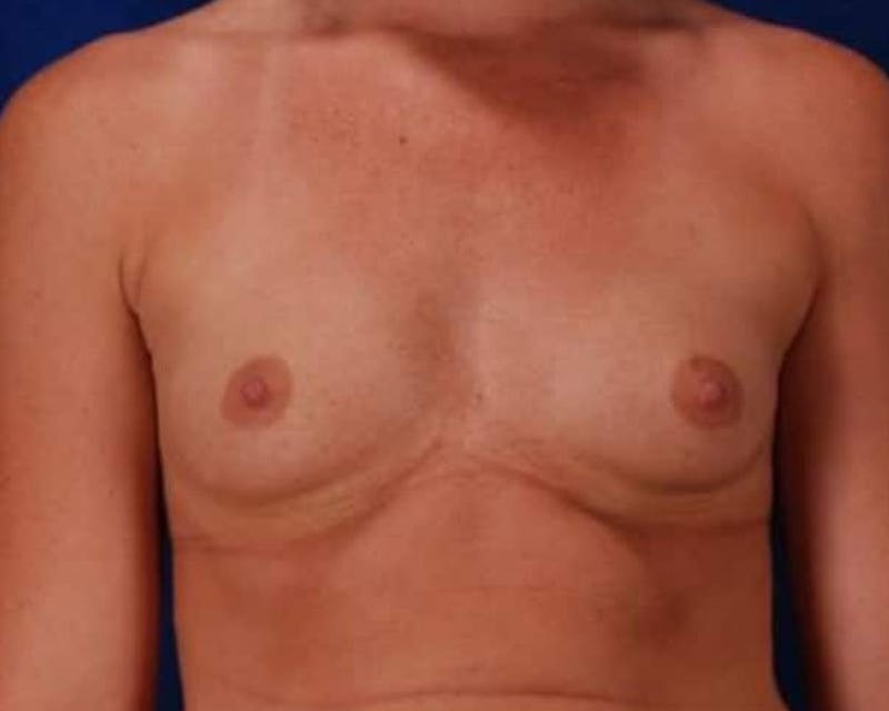 Breast Augmentation Before & After Gallery - Patient 206266 - Image 1