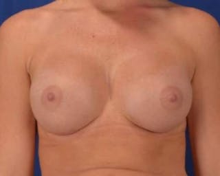 Breast Augmentation Before & After Gallery - Patient 206266 - Image 2