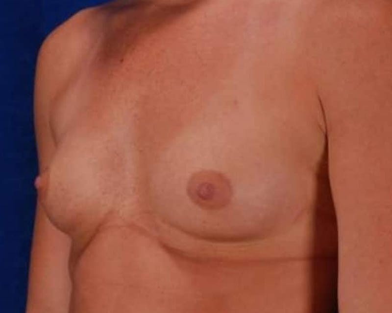 Breast Augmentation Before & After Gallery - Patient 206266 - Image 3