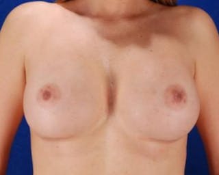 Breast Augmentation Before & After Gallery - Patient 586436 - Image 2