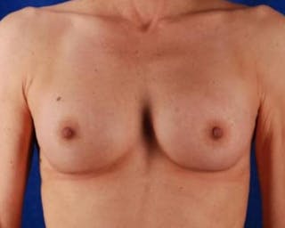 Breast Augmentation Before & After Gallery - Patient 154561 - Image 2