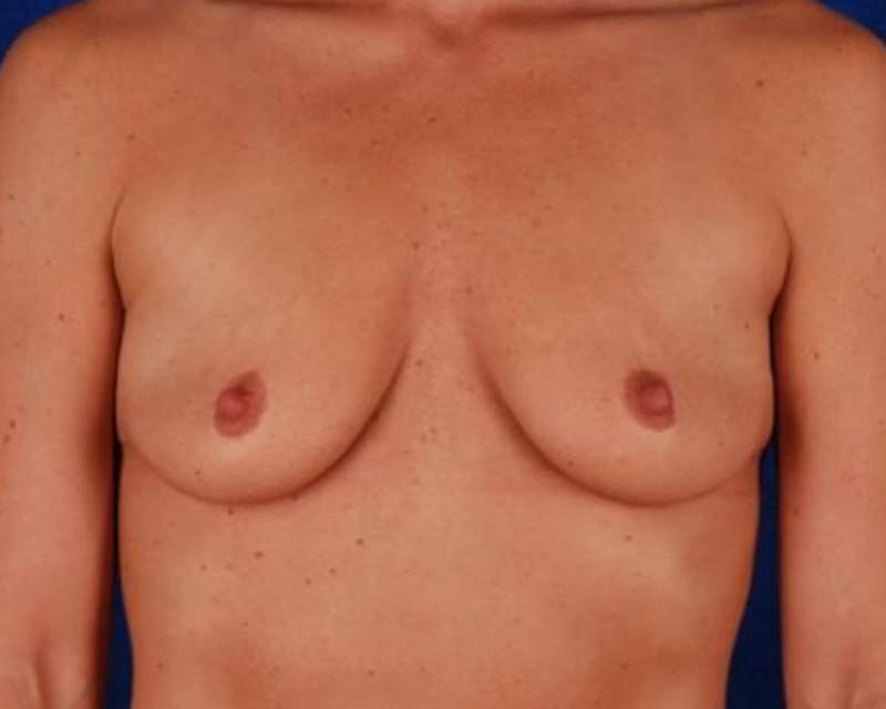 Breast Augmentation Before & After Gallery - Patient 127204 - Image 1