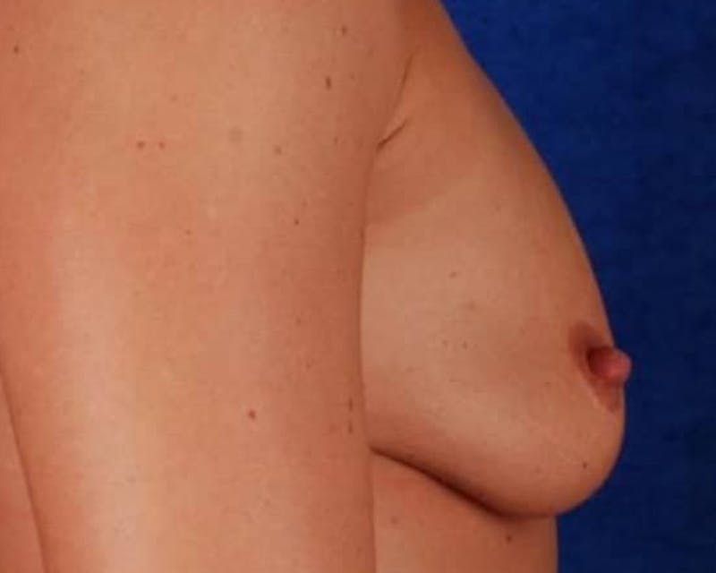 Breast Augmentation Before & After Gallery - Patient 127204 - Image 3