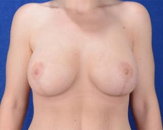 Breast Lift with Augmentation Before & After Gallery - Patient 893252 - Image 2