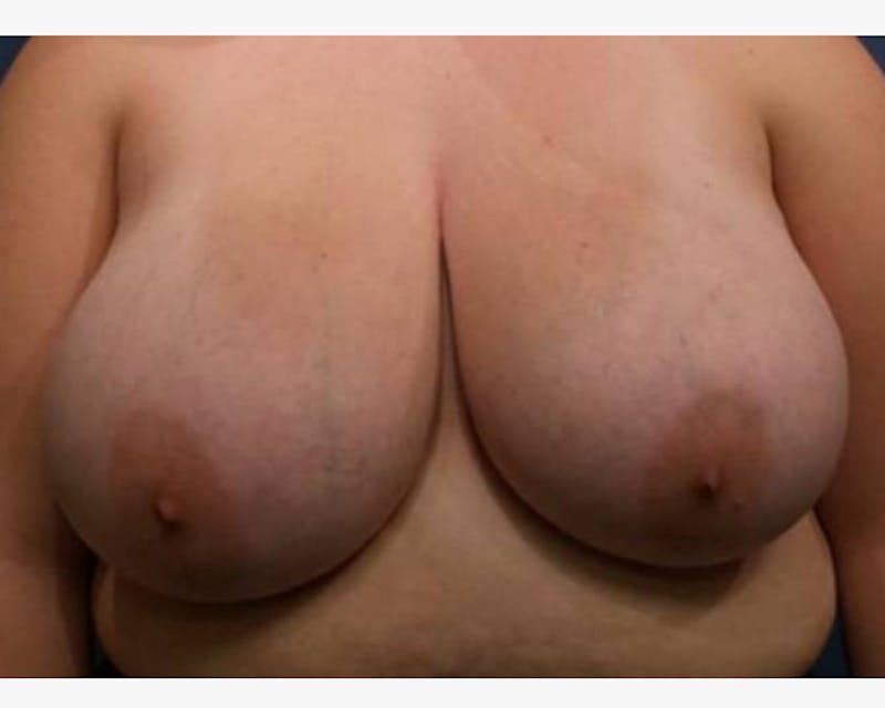 Breast Reduction Before & After Gallery - Patient 258939 - Image 1