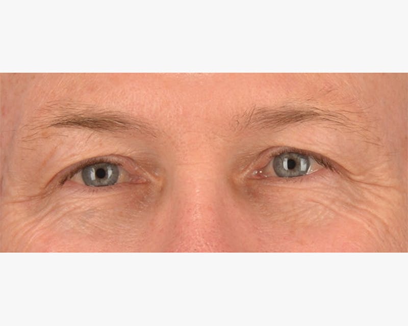 Blepharoplasty Before & After Gallery - Patient 210630 - Image 1