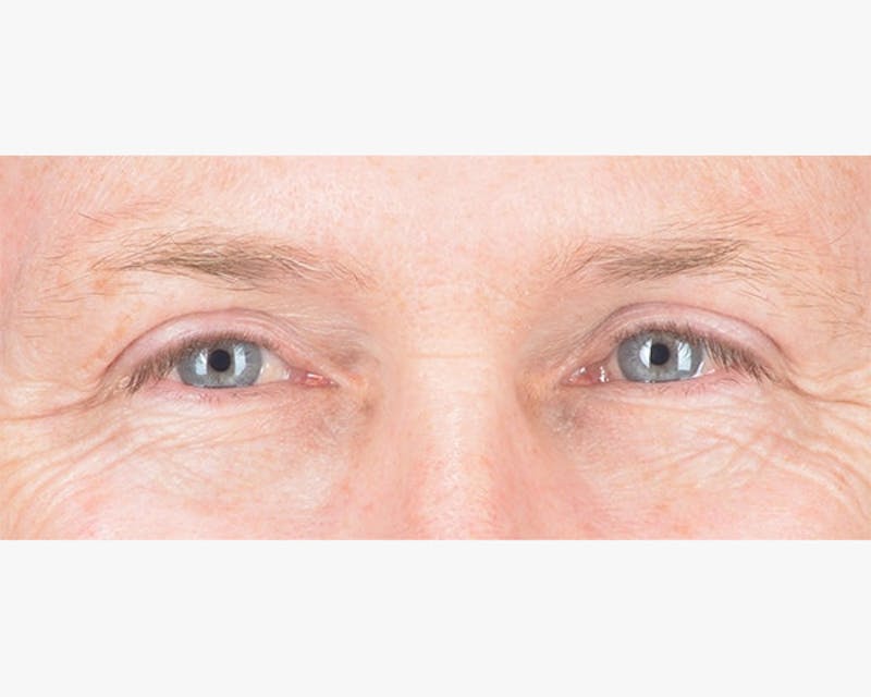 Blepharoplasty Before & After Gallery - Patient 210630 - Image 2