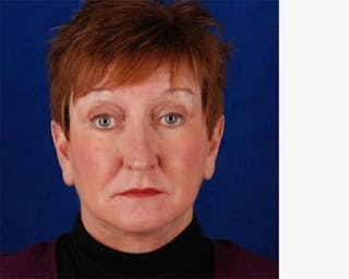 Blepharoplasty Before & After Gallery - Patient 317380 - Image 2