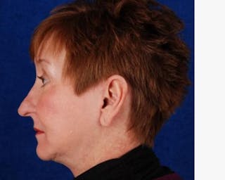 Blepharoplasty Before & After Gallery - Patient 317380 - Image 4