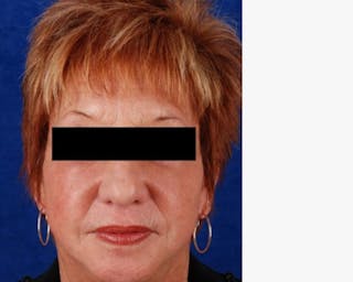 Face Lift Before & After Gallery - Patient 783930 - Image 2